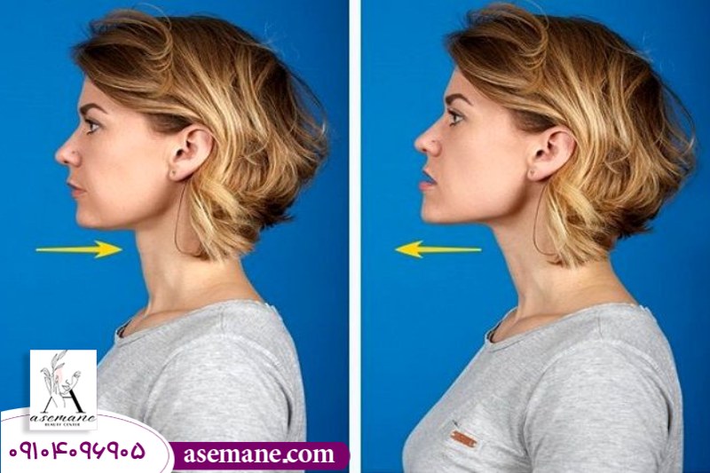 لیپوساکشن برای حذف غبغب 